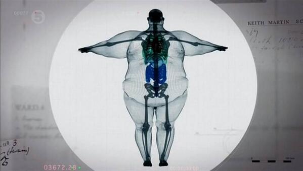 JANIS-EN-SUCRE-le-tour-du-web-16-homme de 200kg aux rayons x